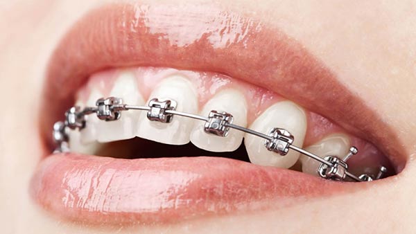 Metal braces treatment in chandigarh